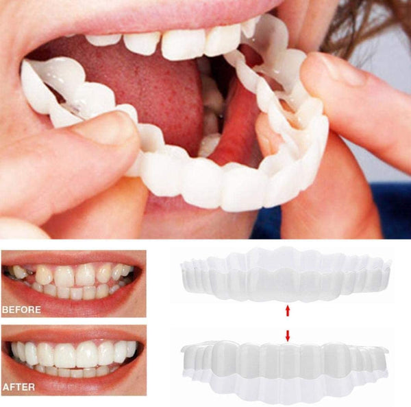 SmileGuard™ Veneers – Professionelle Snap-On Zahnverblendung für ein perfektes Lächeln
