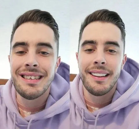 SmileGuard™ Veneers – Professionelle Snap-On Zahnverblendung für ein perfektes Lächeln