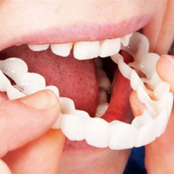 SmileSnap™ Perfect Veneer – Snap-On Veneers für ein sofortiges, strahlendes Lächeln