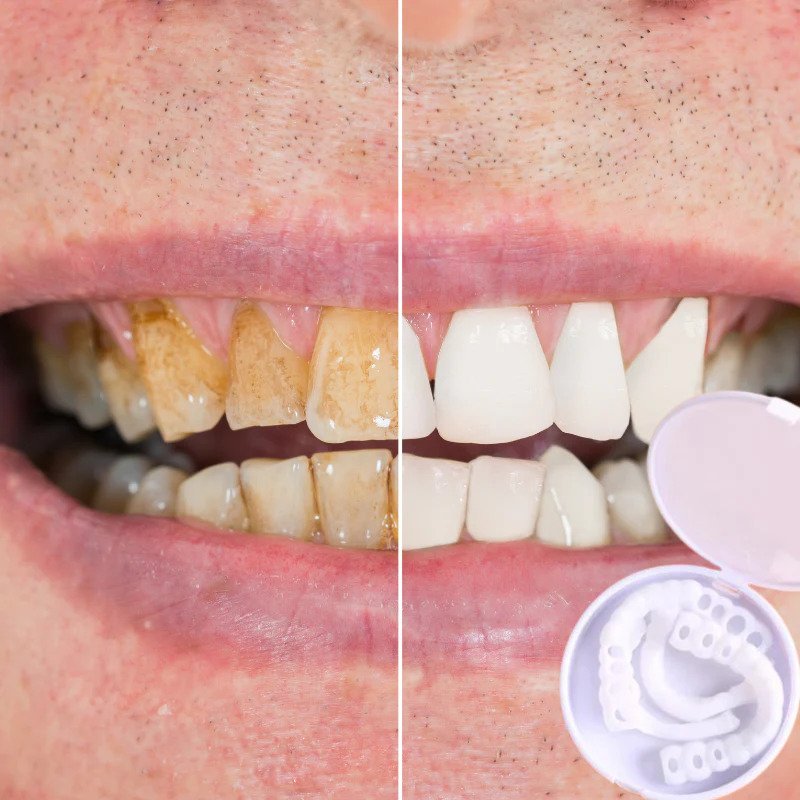 SmileSnap™ Perfect Veneer – Snap-On Veneers für ein sofortiges, strahlendes Lächeln